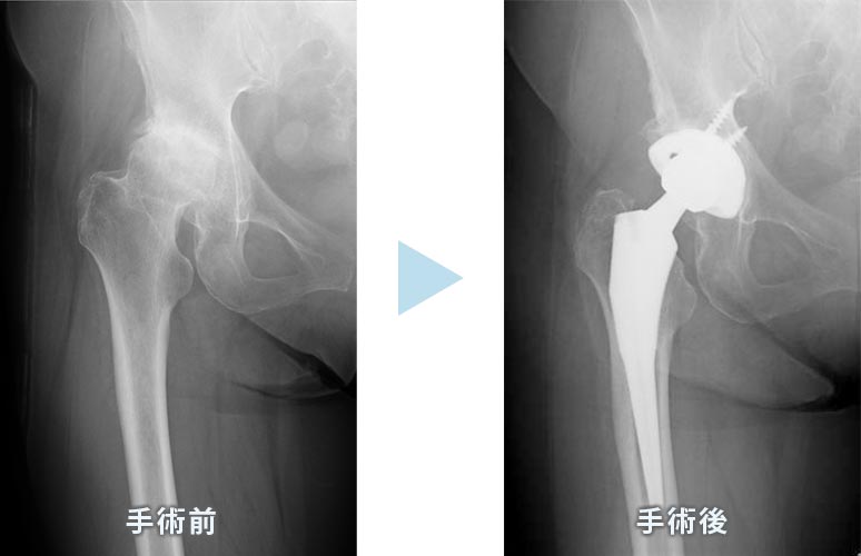 図① 股関節の人工関節手術